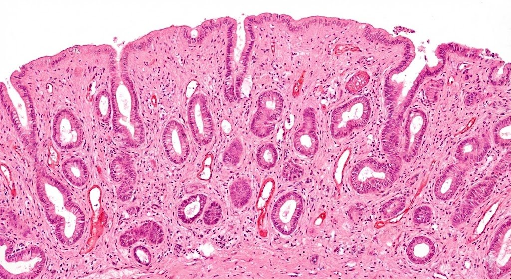Como é feito preparo de endométrio